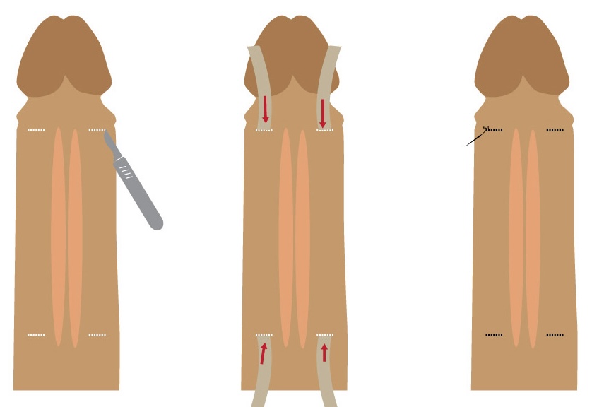 G1增大增長手術＿1, 壯陽藥, 壯陽產品, 壯陽中藥, 威而鋼, 犀利士, 必利勁, 樂威壯, 樂軒昂, 壯陽產品, 勃起障礙, 必利勁, 瑪卡, 藍色小藥丸, 偉哥, 武倍對策, 我弟很猛, 增大增粗